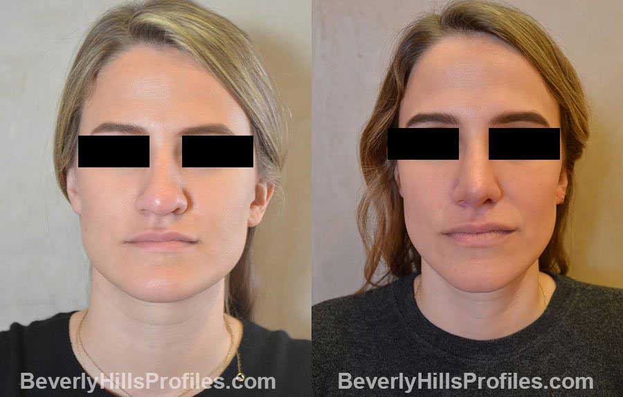rhinoplasty85-ba1