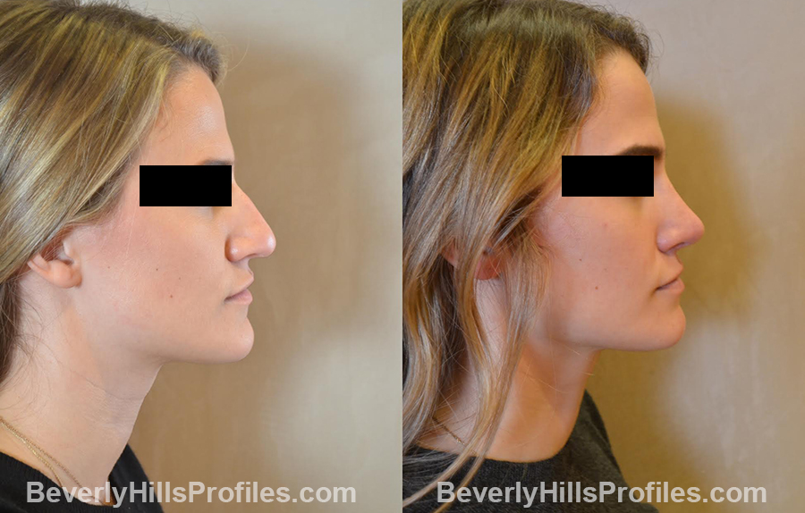 rhinoplasty85-ba3