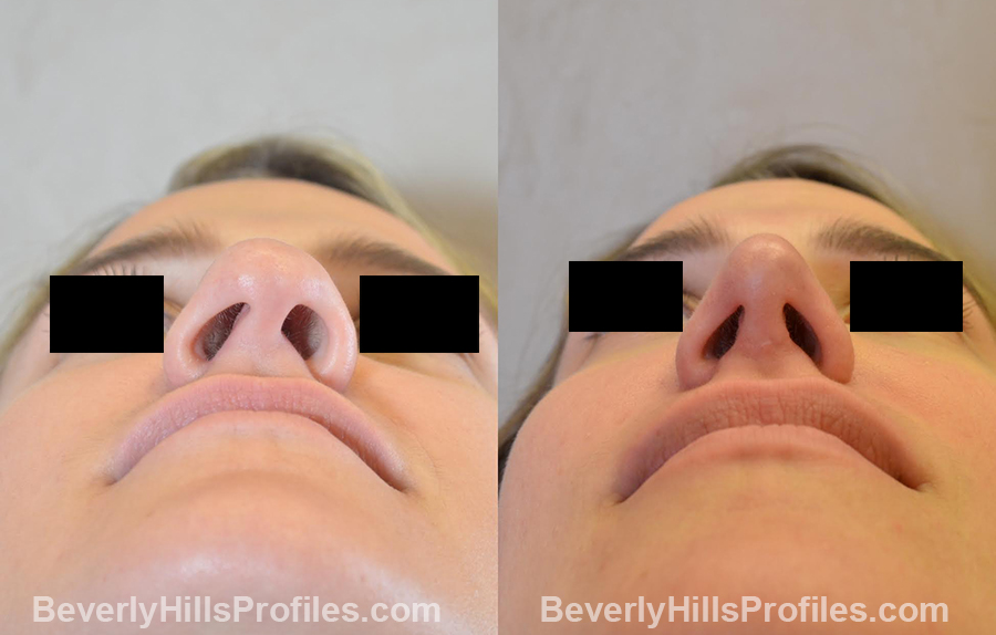 rhinoplasty85-ba6